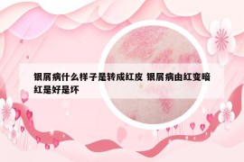 银屑病什么样子是转成红皮 银屑病由红变暗红是好是坏