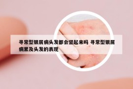 寻常型银屑病头发都会竖起来吗 寻常型银屑病累及头发的表现