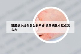 银屑病小红包怎么老不好 银屑病起小红点怎么办