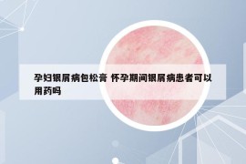孕妇银屑病包松膏 怀孕期间银屑病患者可以用药吗