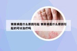 银屑病是什么原因引起 银屑病是什么原因引起的可以治疗吗