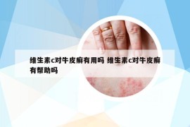 维生素c对牛皮癣有用吗 维生素c对牛皮癣有帮助吗