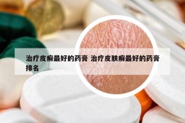 治疗皮癣最好的药膏 治疗皮肤癣最好的药膏排名