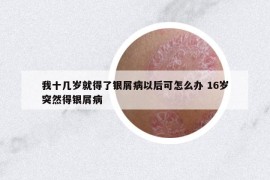 我十几岁就得了银屑病以后可怎么办 16岁突然得银屑病