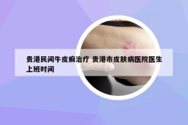贵港民间牛皮癣治疗 贵港市皮肤病医院医生上班时间