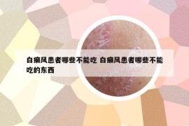 白癞风患者哪些不能吃 白癞风患者哪些不能吃的东西