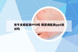 有牛皮癣能做PPD吗 银屑病能做ppd皮试吗
