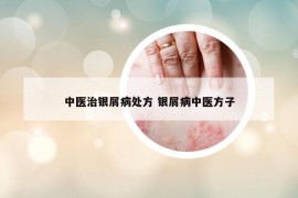 中医治银屑病处方 银屑病中医方子