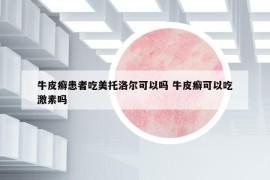 牛皮癣患者吃美托洛尔可以吗 牛皮癣可以吃激素吗