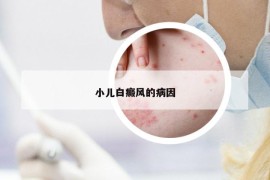 小儿白癜风的病因