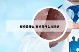 顽癣是什么 顽癣是什么皮肤病