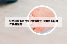 佳木斯哪家医院看皮肤病最好 佳木斯最好的皮肤病医院