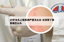 20岁女头上银屑病严重怎么办 女孩得了银屑病怎么办
