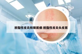 脱脂性皮炎和银屑病 脱脂性皮炎头皮屑