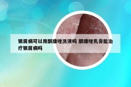银屑病可以用酮康唑洗液吗 酮康唑乳膏能治疗银屑病吗