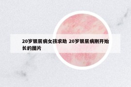 20岁银屑病女孩求助 20岁银屑病刚开始长的图片