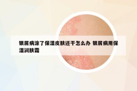 银屑病涂了保湿皮肤还干怎么办 银屑病用保湿润肤霜