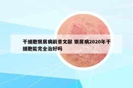 干细胞银屑病前景文献 银屑病2020年干细胞能完全治好吗
