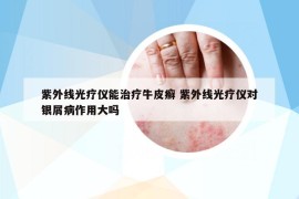 紫外线光疗仪能治疗牛皮癣 紫外线光疗仪对银屑病作用大吗