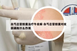 白芍总苷胶囊治疗牛皮癣 白芍总苷胶囊对皮肤病有什么作用