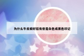 为什么牛皮癣好后有些是白色或黑色印记
