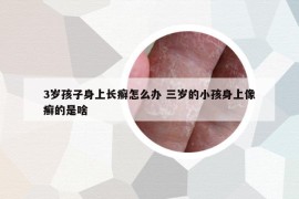 3岁孩子身上长癣怎么办 三岁的小孩身上像癣的是啥