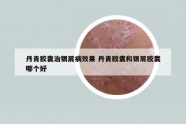 丹青胶囊治银屑病效果 丹青胶囊和银屑胶囊哪个好