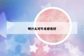 喝什么对牛皮癣有好