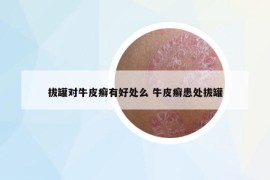 拔罐对牛皮癣有好处么 牛皮癣患处拔罐
