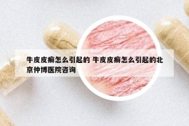牛皮皮癣怎么引起的 牛皮皮癣怎么引起的北京仲博医院咨询