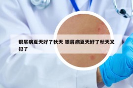 银屑病夏天好了秋天 银屑病夏天好了秋天又犯了