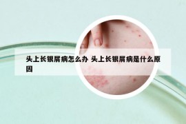 头上长银屑病怎么办 头上长银屑病是什么原因