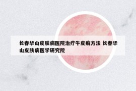 长春华山皮肤病医院治疗牛皮癣方法 长春华山皮肤病医学研究院