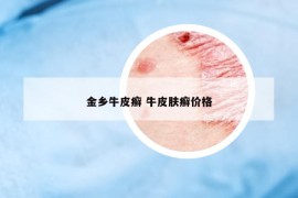 金乡牛皮癣 牛皮肤癣价格