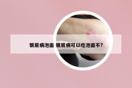 银屑病泡面 银屑病可以吃泡面不?
