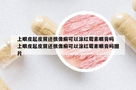 上眼皮起皮屑还很像癣可以涂红霉素眼膏吗 上眼皮起皮屑还很像癣可以涂红霉素眼膏吗图片