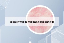 羊奶治疗牛皮癣 牛皮癣可以吃羊奶钙片吗