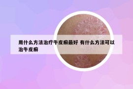 用什么方法治疗牛皮癣最好 有什么方法可以治牛皮癣