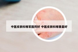 中医皮肤科哪家医院好 中医皮肤科哪里最好