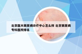 北京医大银屑病诊疗中心怎么样 北京银屑病专科医院排名