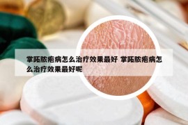 掌跖脓疱病怎么治疗效果最好 掌跖脓疱病怎么治疗效果最好呢