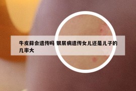 牛皮藓会遗传吗 银屑病遗传女儿还是儿子的几率大