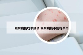 银屑病能吃羊肠子 银屑病能不能吃羊肉