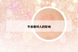 牛皮癣对人的影响
