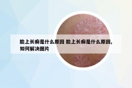 脸上长癣是什么原因 脸上长癣是什么原因,如何解决图片