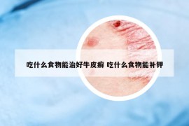 吃什么食物能治好牛皮癣 吃什么食物能补钾