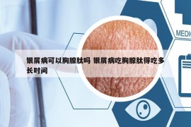 银屑病可以胸腺肽吗 银屑病吃胸腺肽得吃多长时间