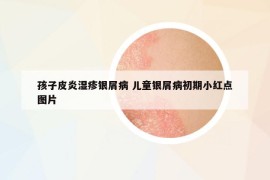 孩子皮炎湿疹银屑病 儿童银屑病初期小红点图片