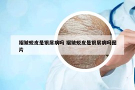 褶皱蜕皮是银屑病吗 褶皱蜕皮是银屑病吗图片