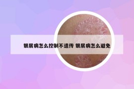 银屑病怎么控制不遗传 银屑病怎么避免